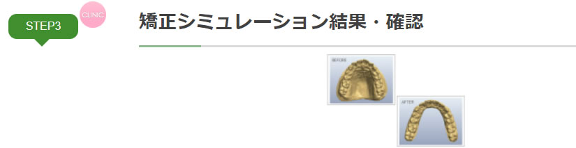 治療の流れ　矯正シミュレーション結果・確認